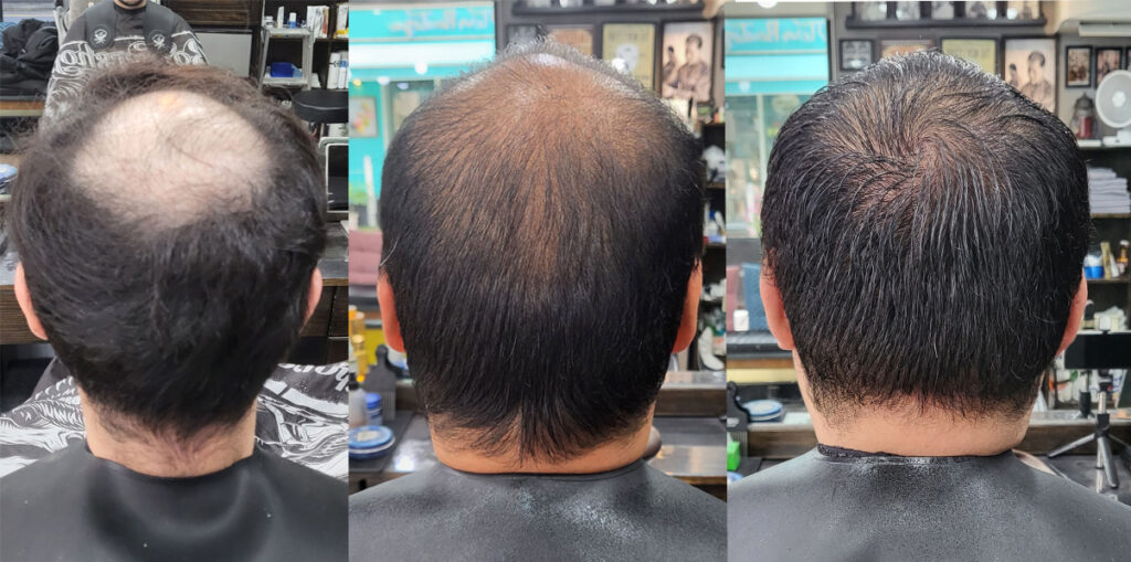 정수리 숱 차이